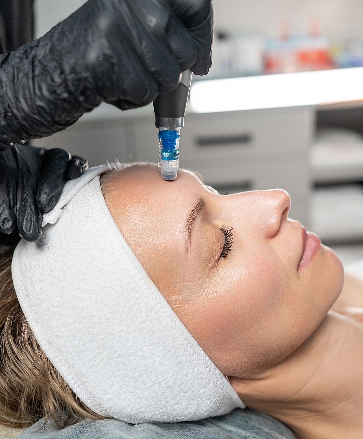 Microneedling treatment on a woman's forehead.