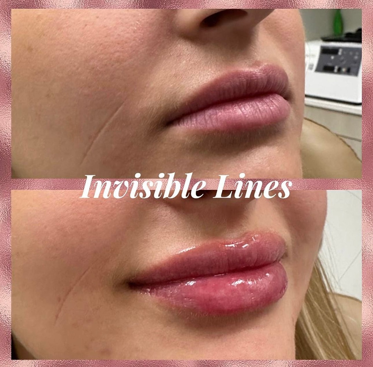 Lip Filler Before & After