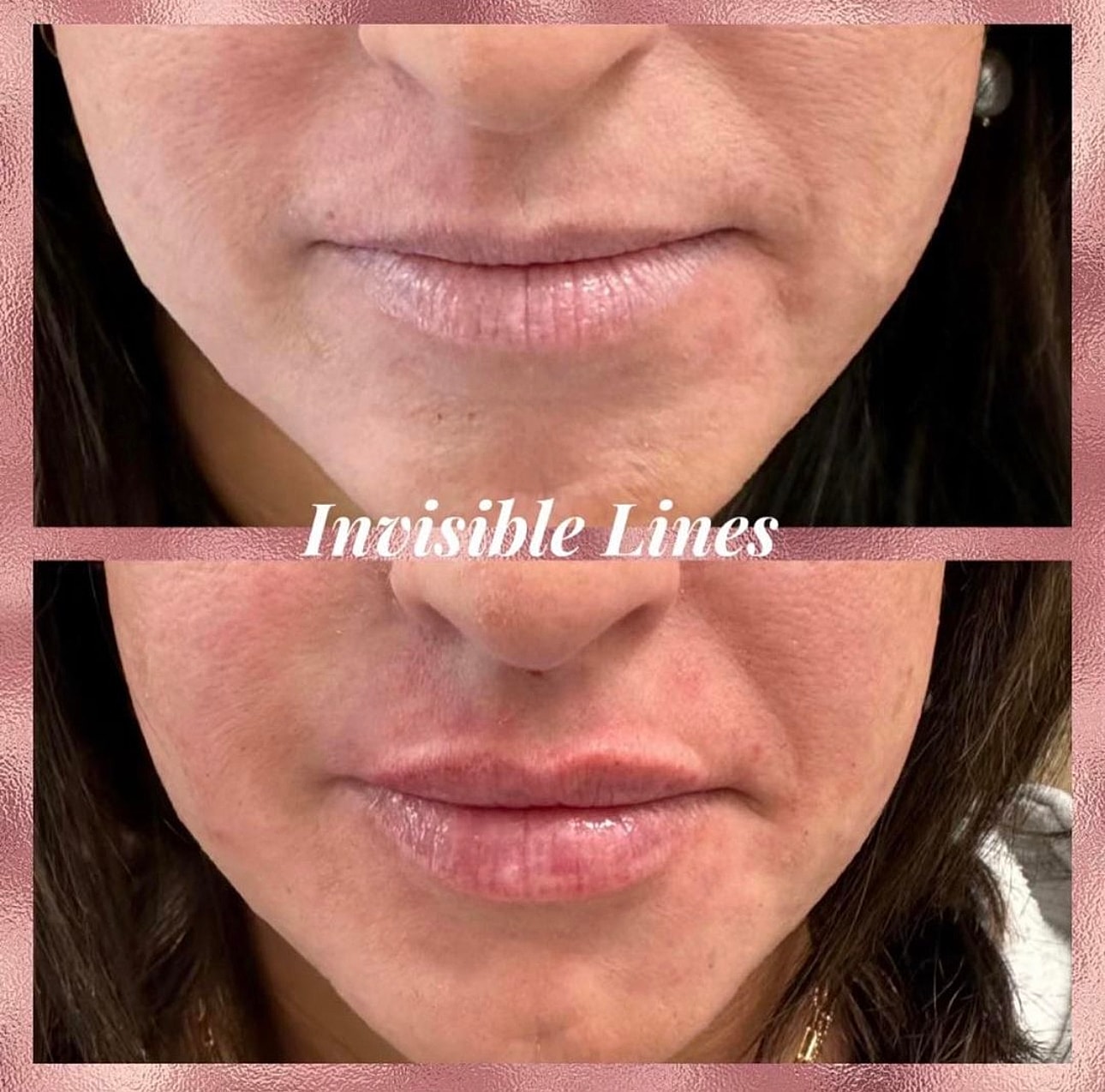 Lip Filler Before & After