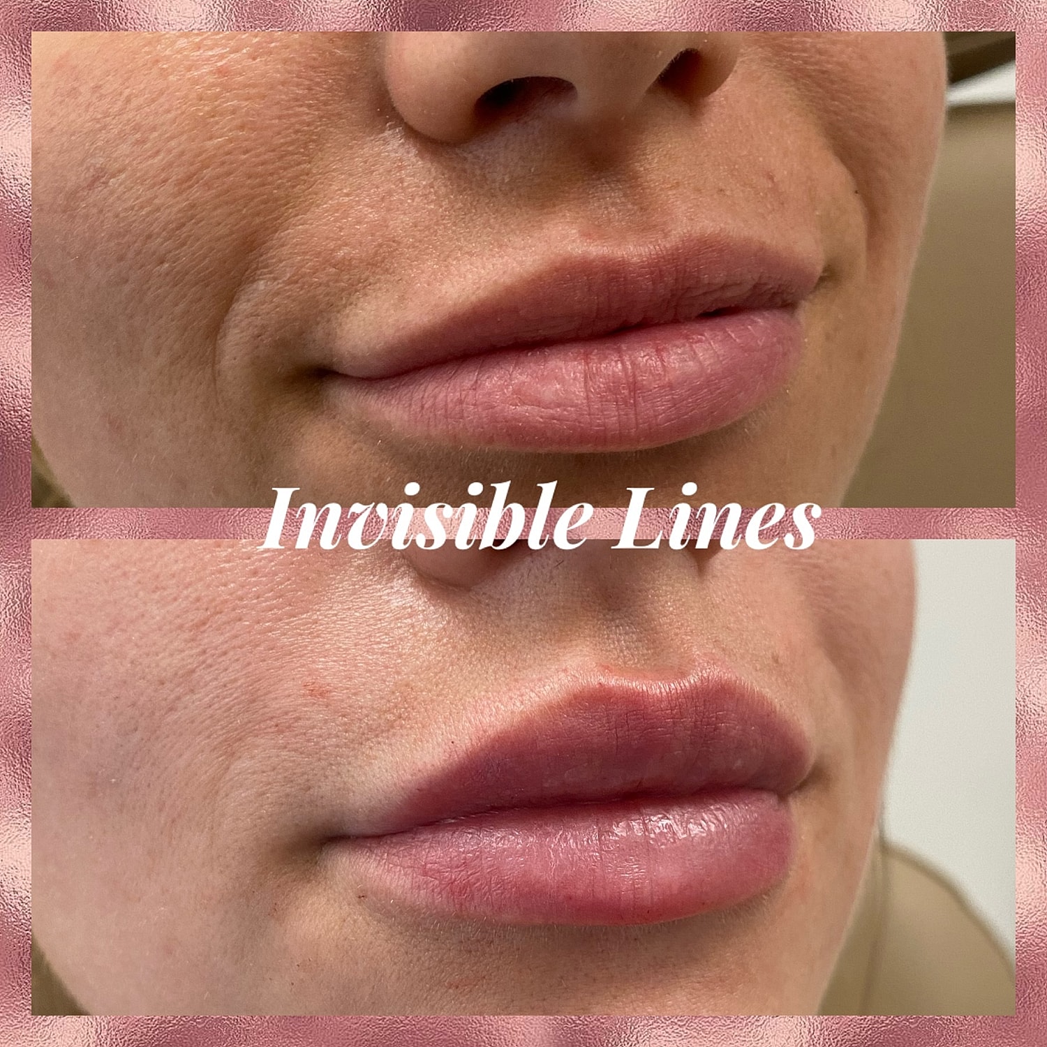Lip Filler Before & After