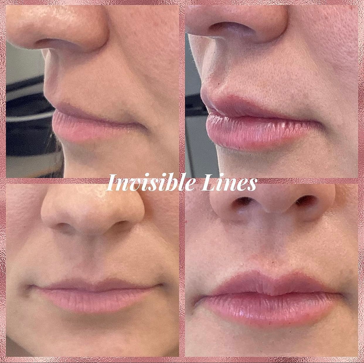 Lip Filler Before & After