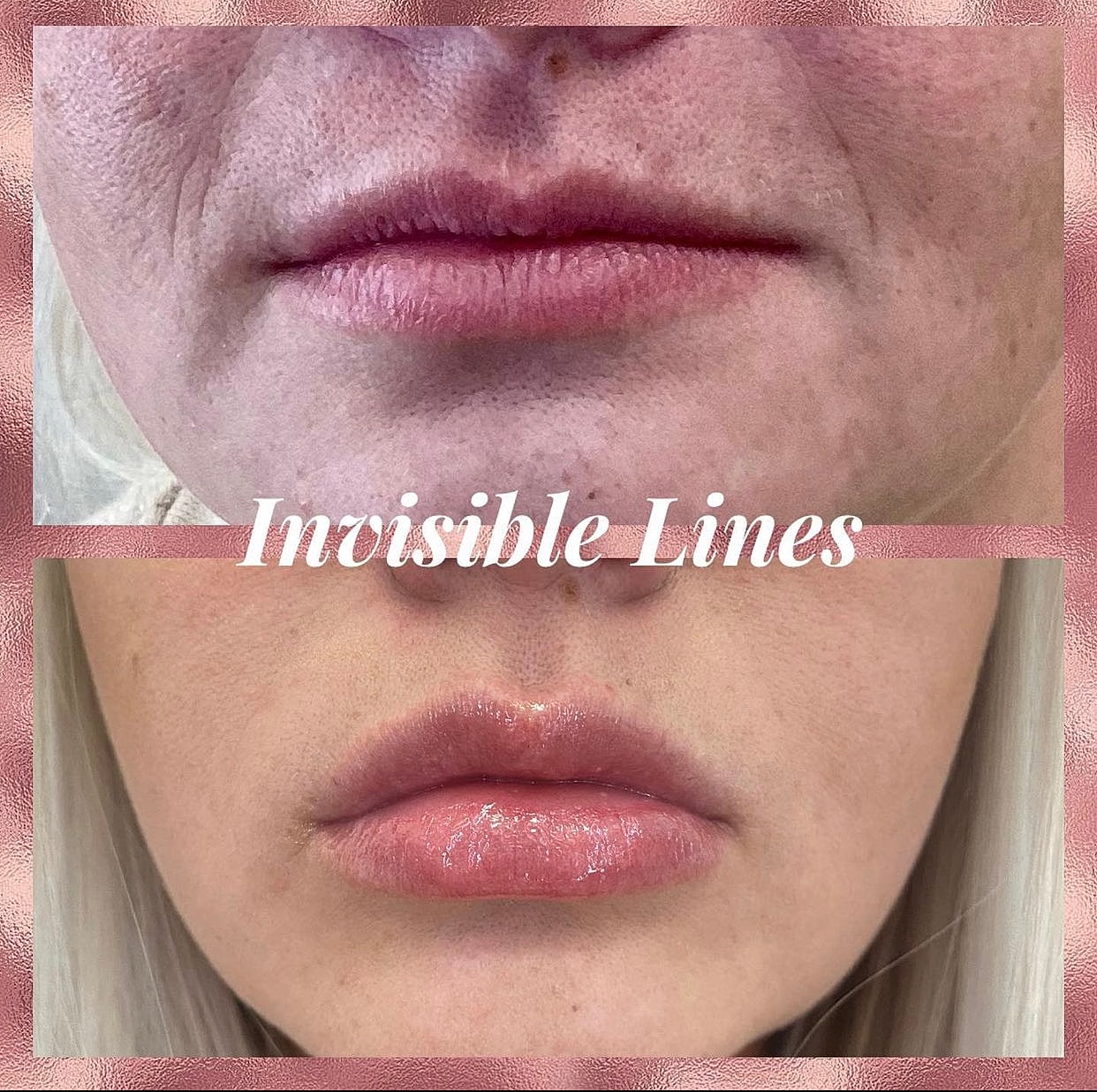 Lip Filler Before & After