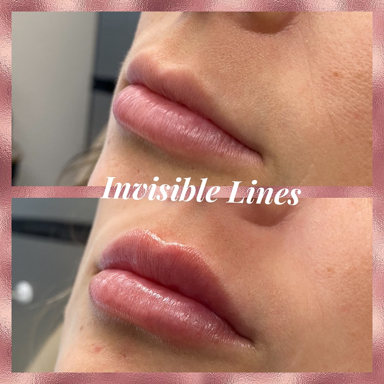 Lip Filler Before & After