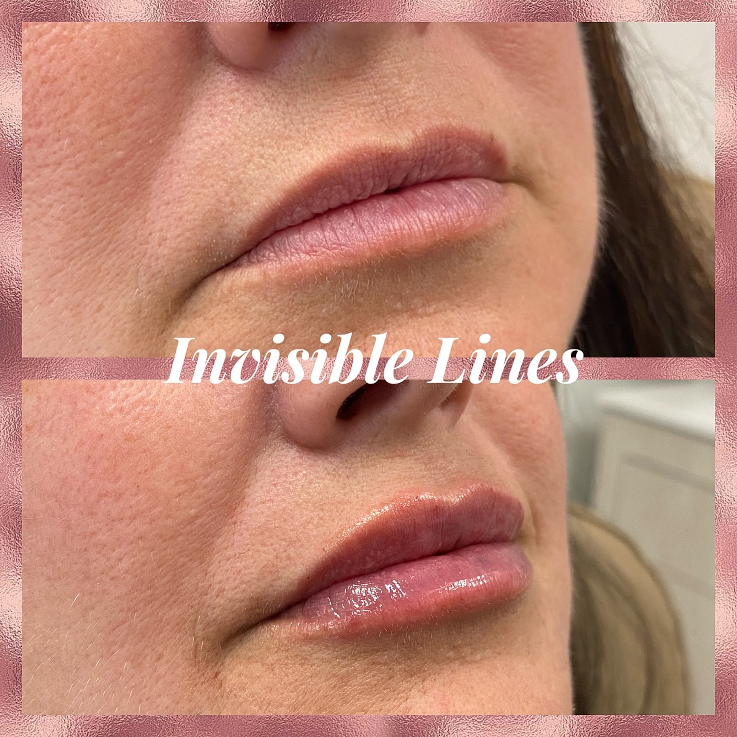 Lip Filler Before & After