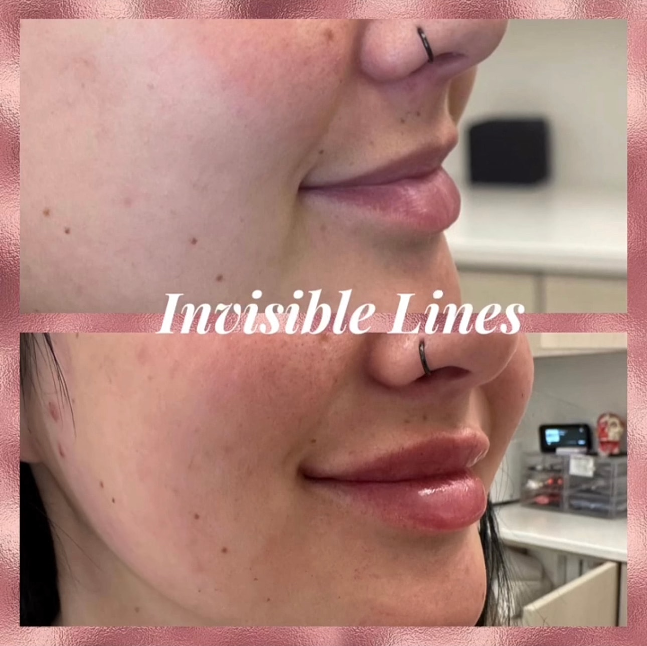Lip Filler Before & After