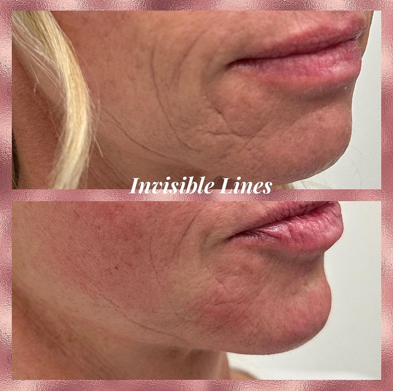 Dermal Fillers Before & After