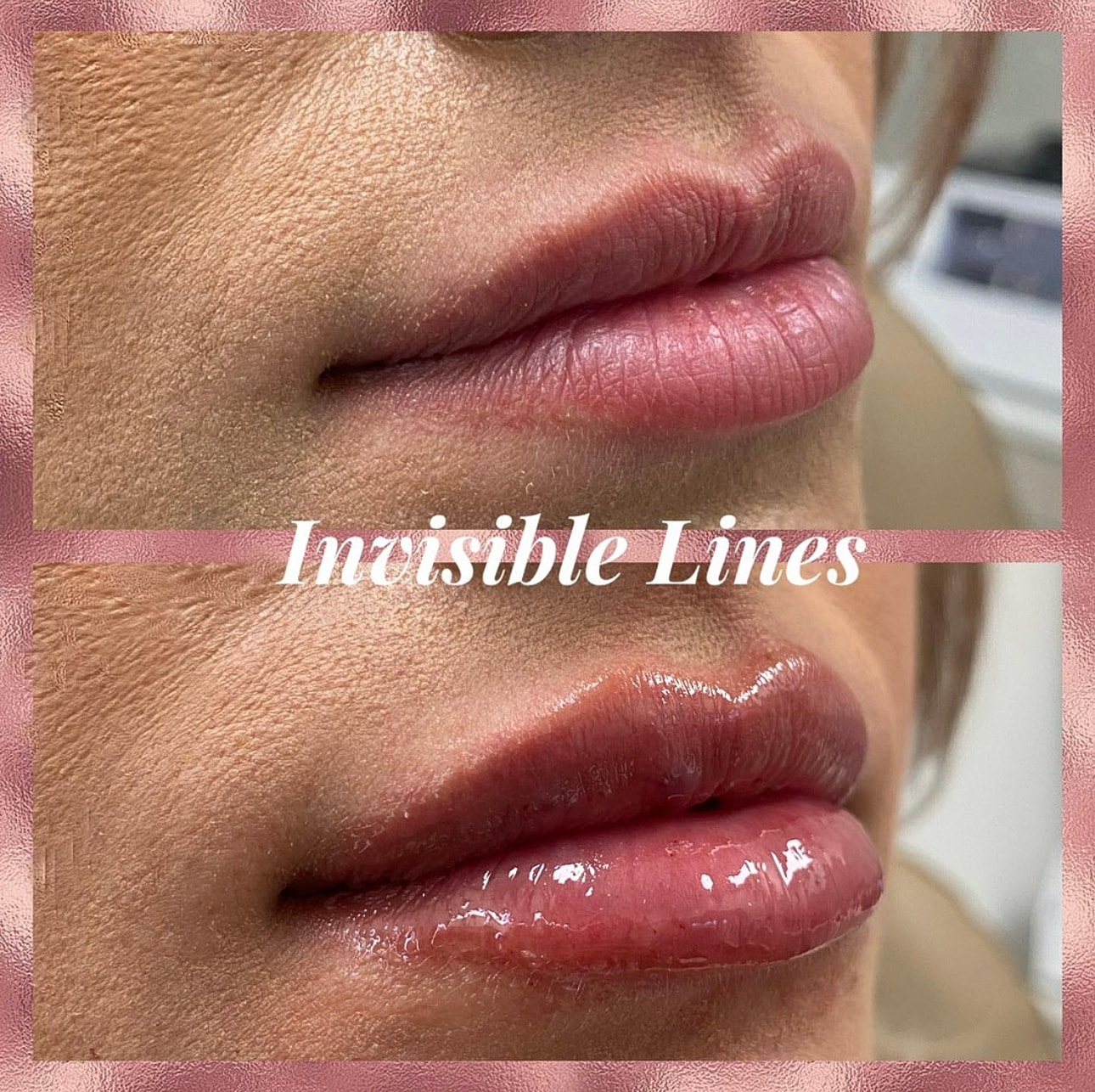 Lip Filler Before & After