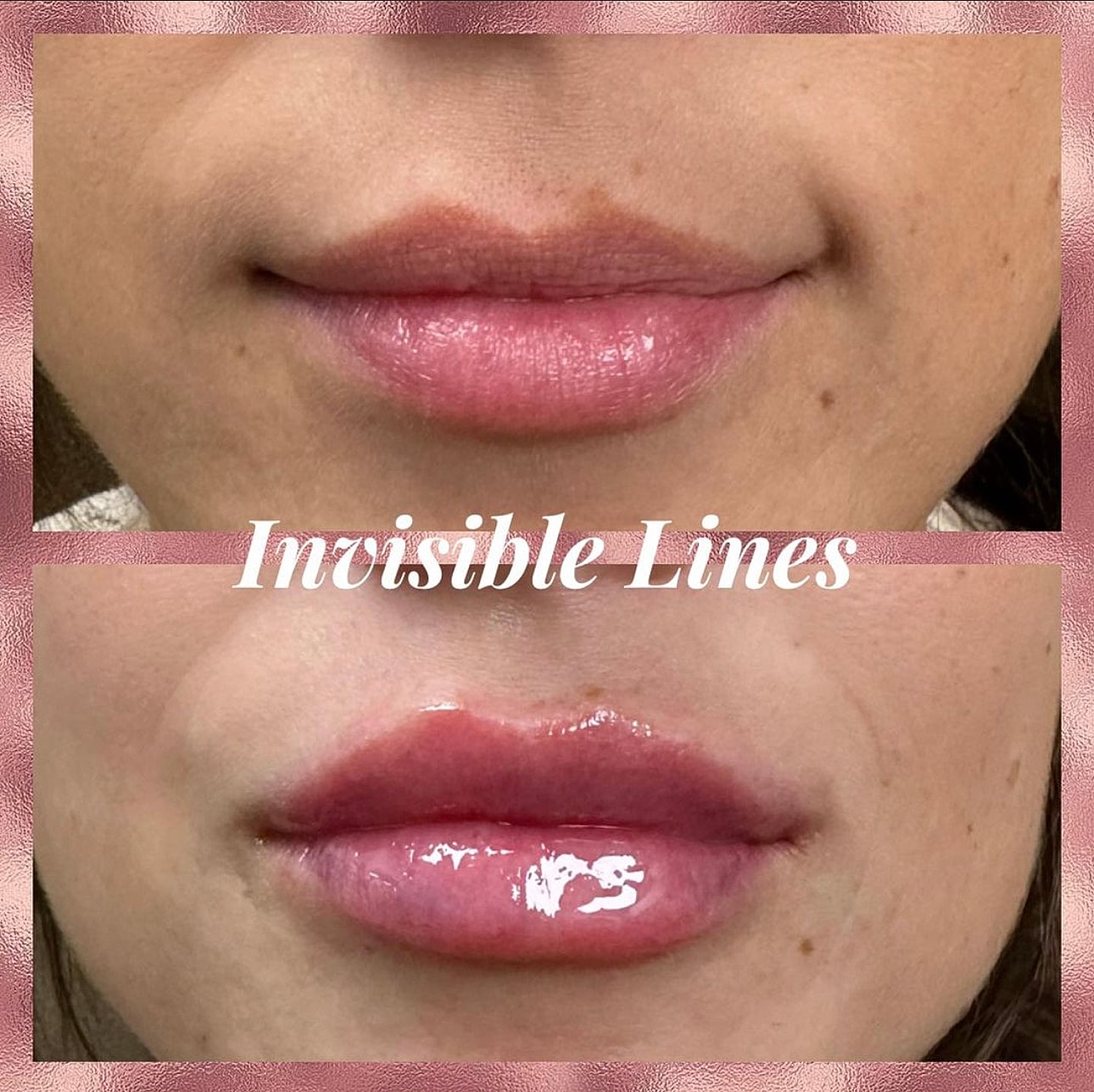 Lip Filler Before & After