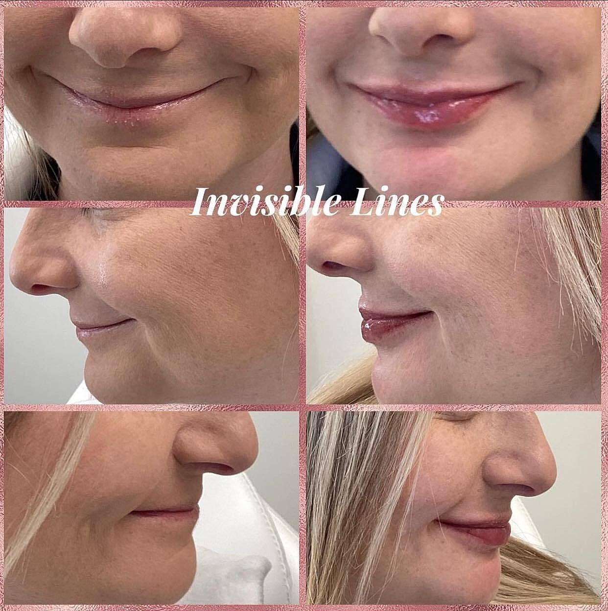 Lip Filler Before & After