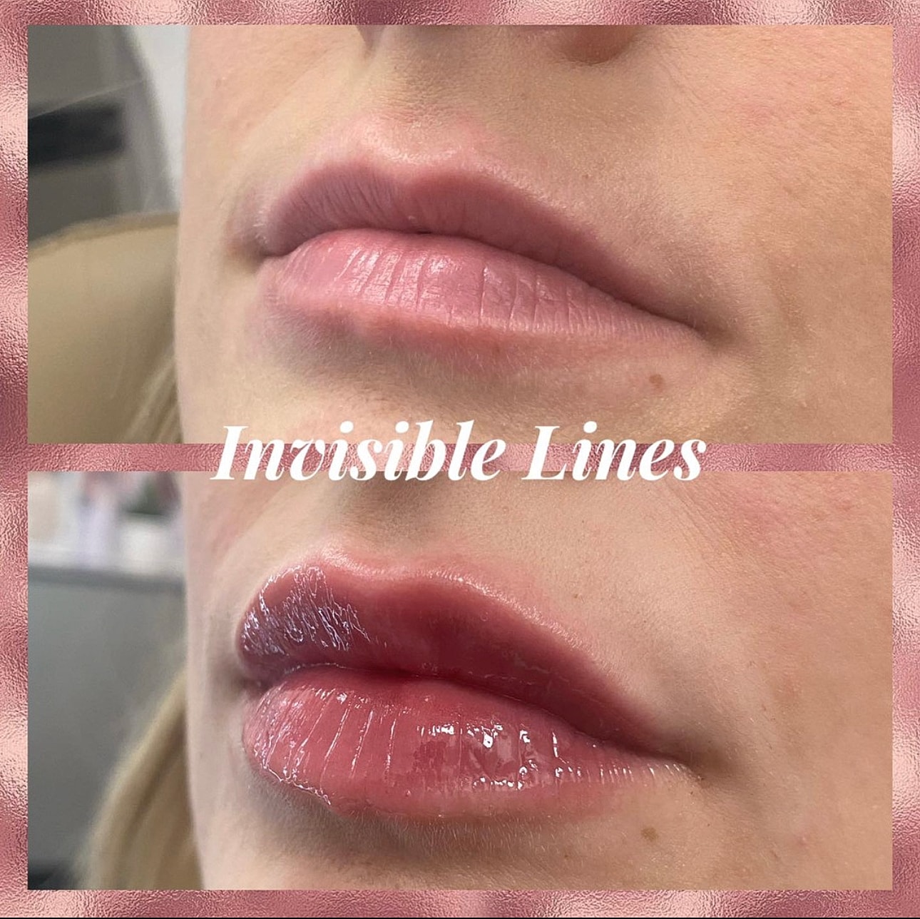 Lip Filler Before & After