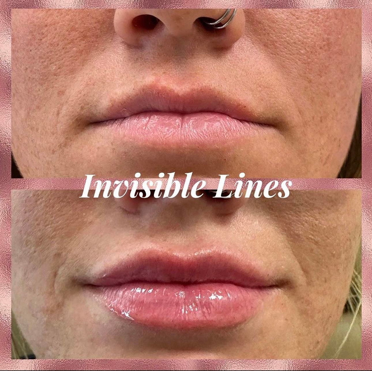 Lip Filler Before & After