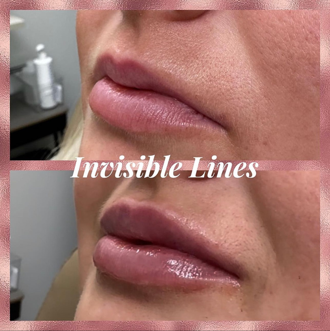 Lip Filler Before & After
