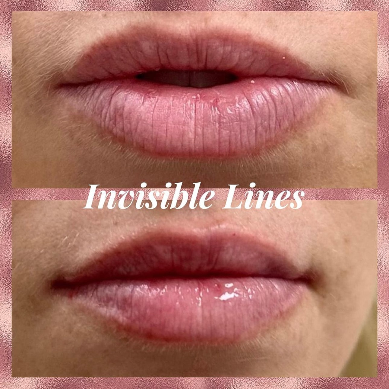 Lip Filler Before & After