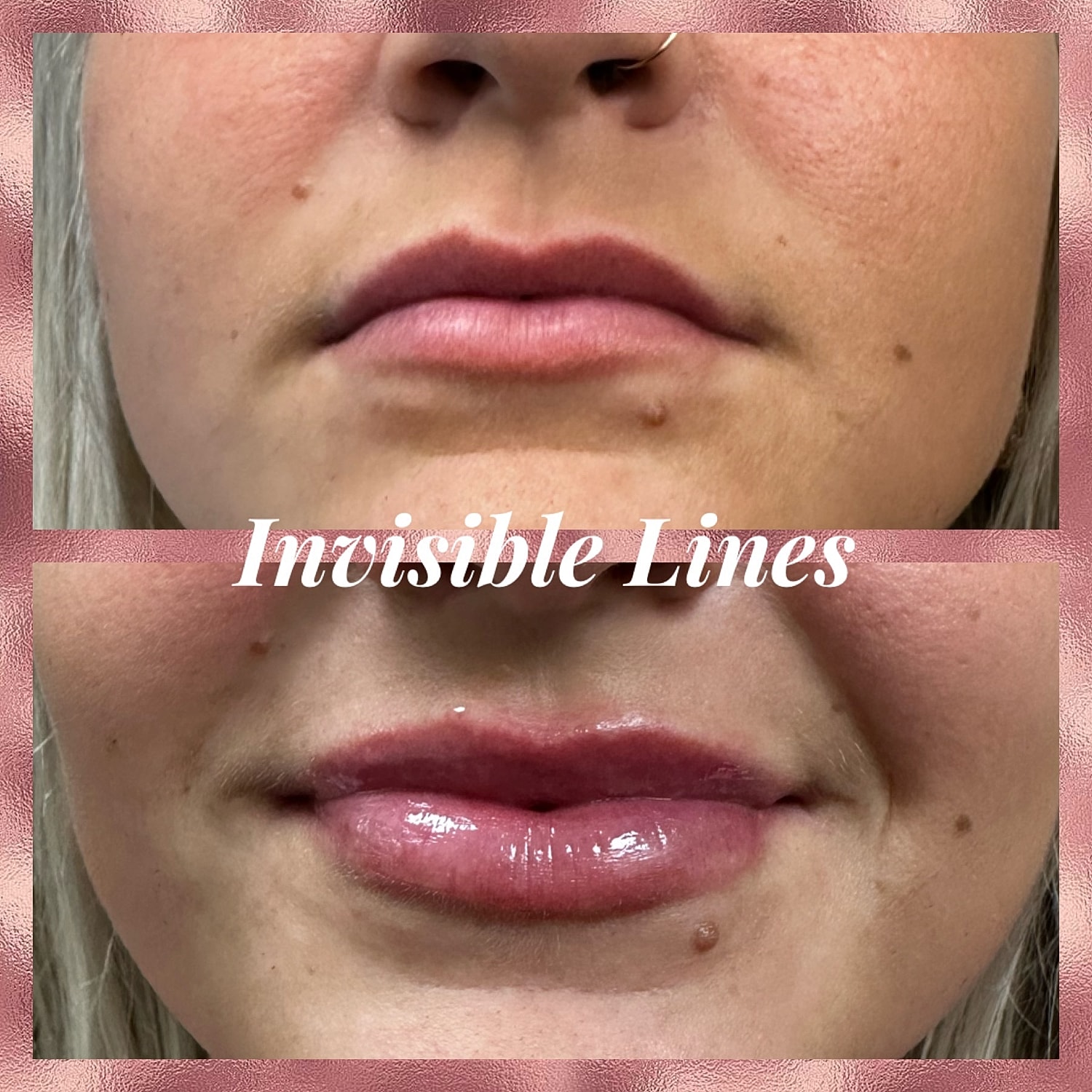 Lip Filler Before & After