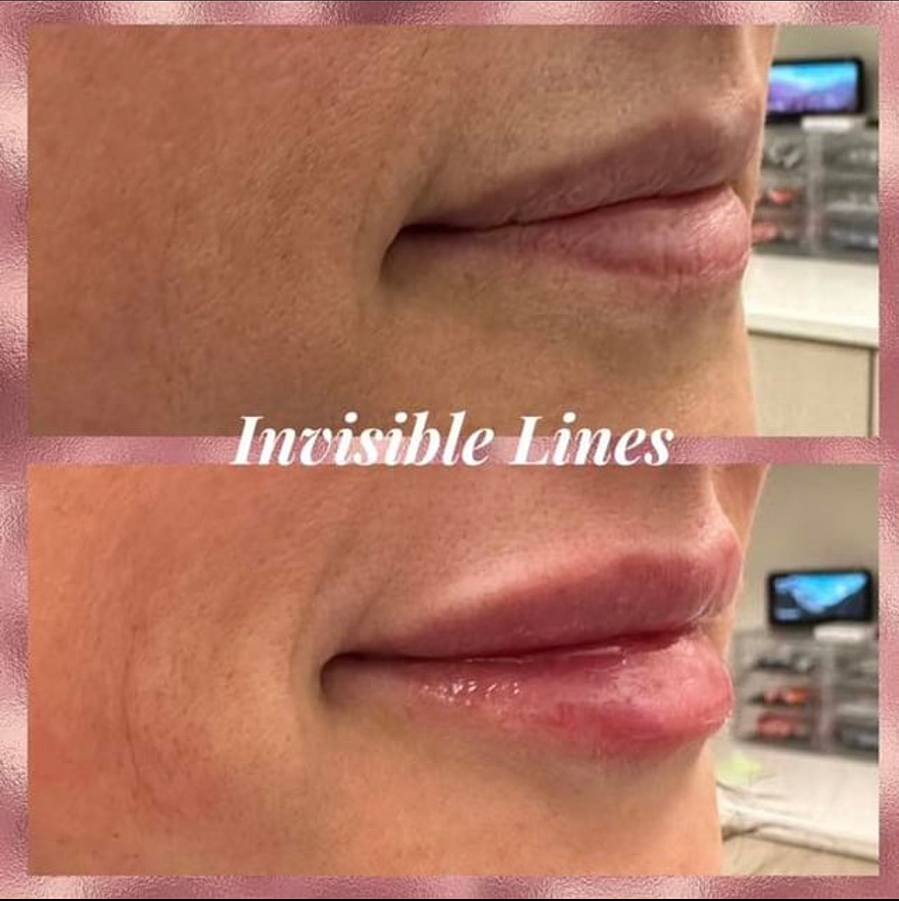 Lip Filler Before & After