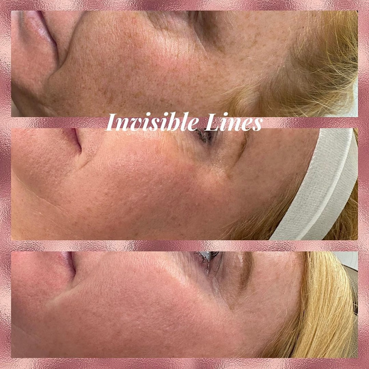 Microneedling Before & After